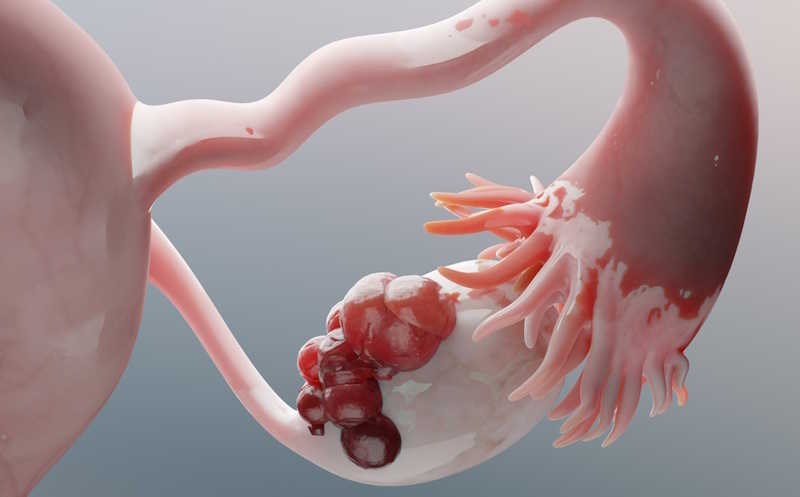 Модель Ovatools предсказывает риск рака яичников точнее, чем стандартный тест